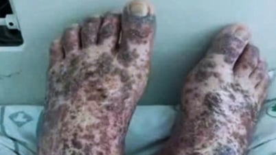 Căn bệnh hiếm khiến cô gái 17 ở TPHCM tuổi bỗng xuất huyết toàn thân
