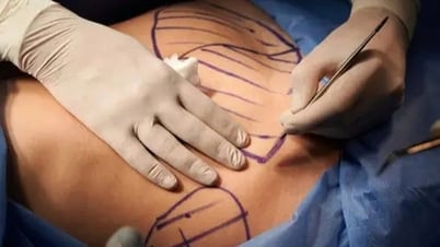 Nam giới chi hàng chục nghìn USD "dao kéo" để có cơ bụng 6 múi