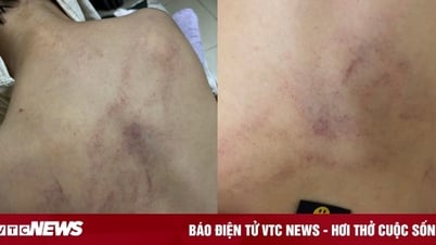 Vụ bé gái 4 tuổi bị đánh tím lưng: Đình chỉ thêm 1 giáo viên