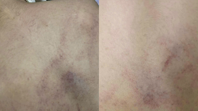 Phụ huynh ở Hà Nội tố giáo viên đánh trẻ mầm non bầm tím lưng