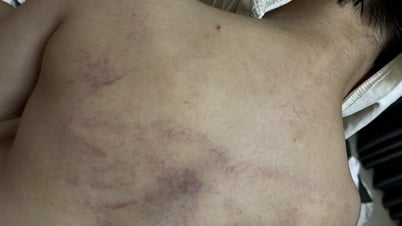 Sở GD-ĐT Hà Nội yêu cầu khẩn trương xác minh việc trẻ nghi bị giáo viên bạo hành