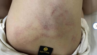 Vụ trẻ nghi bị giáo viên mầm non bạo hành: Công an vào cuộc xác minh