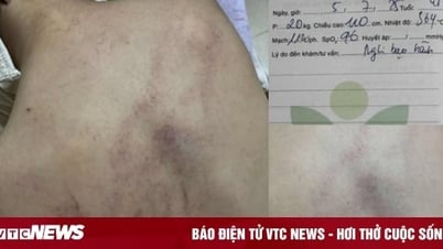 Bé gái 4 tuổi bị cô giáo ném vào tường, đánh tím lưng: Bộ Y tế vào cuộc
