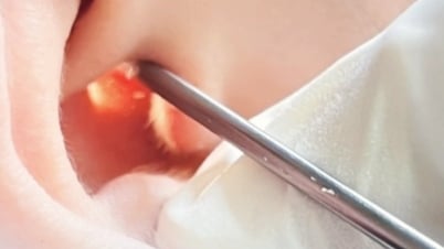 TPHCM: Cấp cứu người mẹ thủng màng nhĩ vì con trai chơi bóng trong nhà