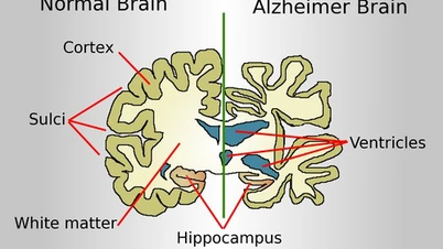 China setzt beliebte Alzheimer-Operation aus