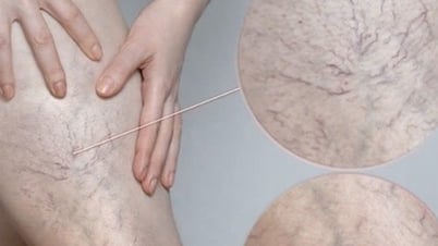Chân đau nhức, mạch máu lộ rõ cảnh báo bệnh lý đang đe dọa 1/3 người trưởng thành