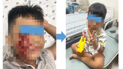 Đang chơi đùa, bé trai bị chó cắn rách má phải