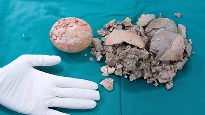 Viên sỏi 'khủng' bằng nắm tay trong bàng quang bệnh nhân 36 tuổi
