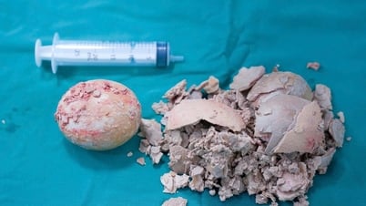 Phẫu thuật lấy sỏi khủng nằm trong người bệnh suốt 30 năm
