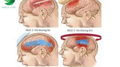 Tổn thương nhu mô não có chữa khỏi không?