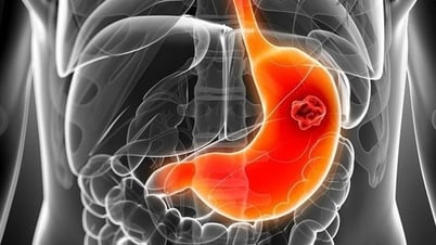 Cách trị viêm loét dạ dày - tá tràng qua bữa ăn