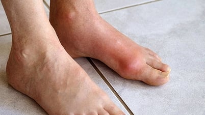 Chàng trai trẻ mắc bệnh gout ở tuổi 22, dấu hiệu cảnh báo từ đau khớp cổ chân