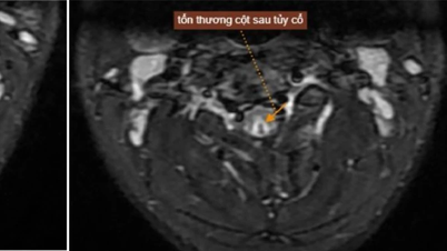 Lạm dụng bóng cười hơn 50 quả mỗi lần, nam thanh niên tổn thương tủy sống