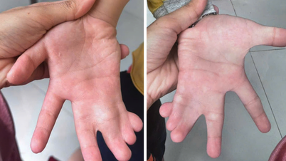 TP.HCM: Phẫu thuật tách bàn tay dính ngón cho bé trai 6 tuổi