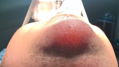 Tiêm filler để chỉnh cằm lẹm, cằm của nam thanh niên bị sưng đỏ như 'phát sáng'