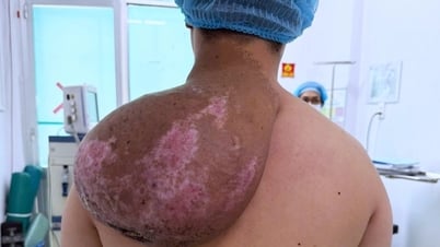 Chàng trai biến dạng cơ thể, 5 năm mang "tảng đá" trên vai vì căn bệnh hiếm
