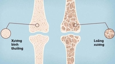 Người trẻ loãng xương sớm do ăn uống thiếu chất và ít vận động