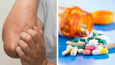 Cơ địa dị ứng uống Histamin liên tục có sao không?