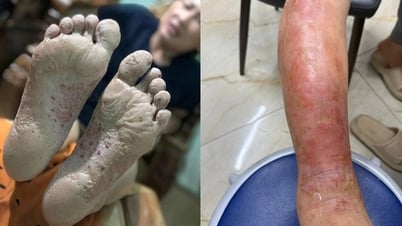 Cẩn trọng với bệnh vùng lũ: Một vết ngứa nhỏ có thể thành ổ nhiễm trùng