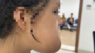 9 giờ liền phẫu thuật miễn phí cho thiếu nữ bị khối u khủng trên mặt