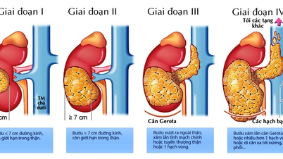Báo động gia tăng ca mắc ung thư thận