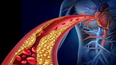 Rối loạn mỡ máu đang trẻ hóa