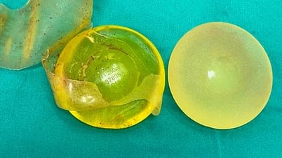 Người đặt túi ngực silicon sau bao lâu nên kiểm tra định kỳ?