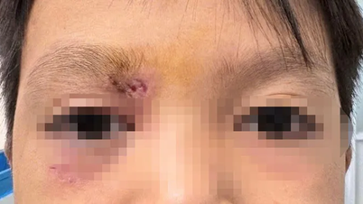 Mảnh gỗ 1,5cm khiến bé trai suýt mù loà