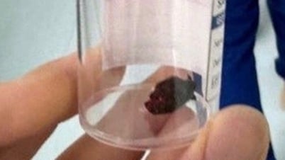 Trẻ suýt mất thị lực vĩnh viễn vì mảnh gỗ dài 1,5cm đâm trúng hốc mắt