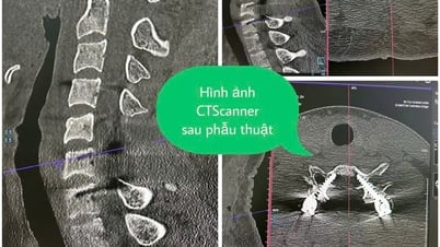 Phẫu thuật thành công cho người nước ngoài bị chấn thương cột sống cổ nặng