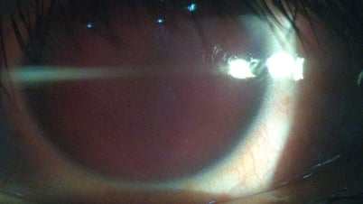 Una lámpara fluorescente explotó y los escombros volaron a través del ojo de un joven.