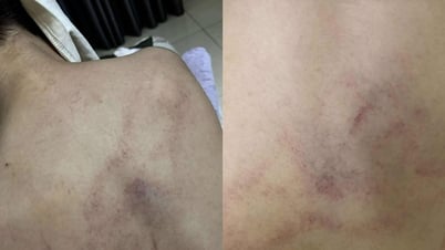 Gia đình tố cô giáo mầm non đánh, kéo lê, ném bé gái 4 tuổi vào tường