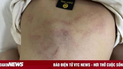 Bé 4 tuổi ở Hà Nội bị giáo viên đánh tím lưng do 'không chịu đi ngủ'