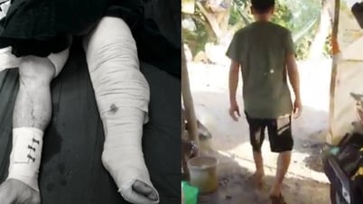 Kỳ diệu: 1 năm sau khi bị tai nạn đứt lìa chân, nam công nhân đã đi được