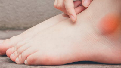 Sưng phù mắt cá chân: 4 căn bệnh nguy hiểm có thể đang mắc