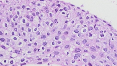 新しい検査で前がん病変を早期に発見