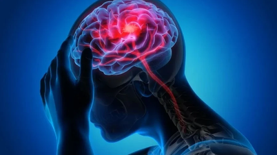 Đột quỵ ngày càng trẻ hóa