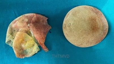 Vỡ túi ngực sau khi nâng cấp vòng 1