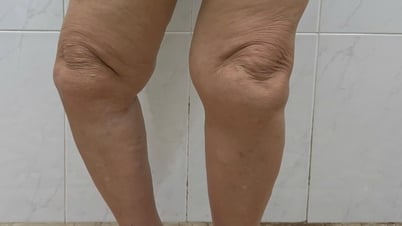 Lấy lại dáng đi cho người phụ nữ 69 tuổi nhờ kỹ thuật thay khớp gối bản lề