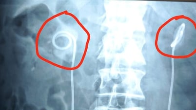 Hombre olvida retirar catéter ureteral durante 2 años y sufre graves complicaciones