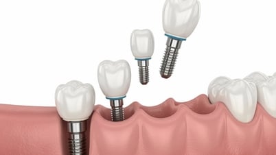 IMPLANTACIÓN DENTAL: SOLUCIÓN PARA PERSONAS QUE LLEVAN PERDIDOS LOS DIENTES DESDE HACE MUCHO TIEMPO