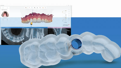 Digital positioning tray “defines” the implant field