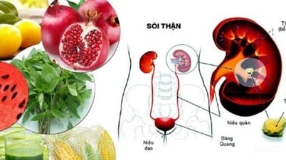 Biện pháp đơn giản hàng đầu giúp đẩy lùi sỏi thận
