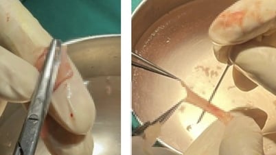TPHCM: Bác sĩ dùng "da trong miệng" để... cứu đường tiểu chàng trai 29 tuổi