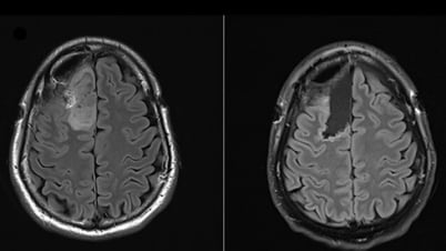Uji klinis pertama di dunia untuk pengobatan tumor otak
