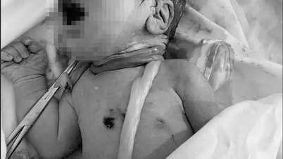 नवजात शिशु का जन्म गर्भनाल के गले में 6 बार लिपटे होने के साथ हुआ