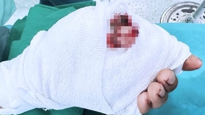 Đi cắt mì phụ giúp gia đình, bé trai 12 tuổi bị đứt hai ngón tay thương tâm