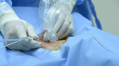 Bước đột phá điều trị hạch cổ tái phát sau mổ ung thư tuyến giáp bằng kỹ thuật đốt sóng cao tần