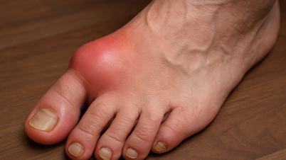 Bệnh gout ngày càng ‘trẻ hóa’ và nguy cơ tổn thương thận