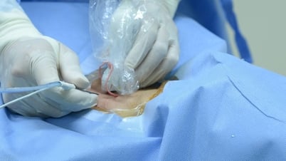 Đột phá mới trong điều trị hạch cổ tái phát sau ung thư tuyến giáp